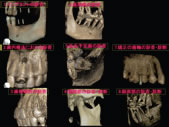 歯科用ＣＴ