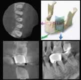 歯科用ＣＴ